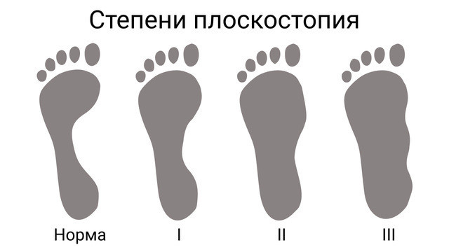Степени плоскостопия