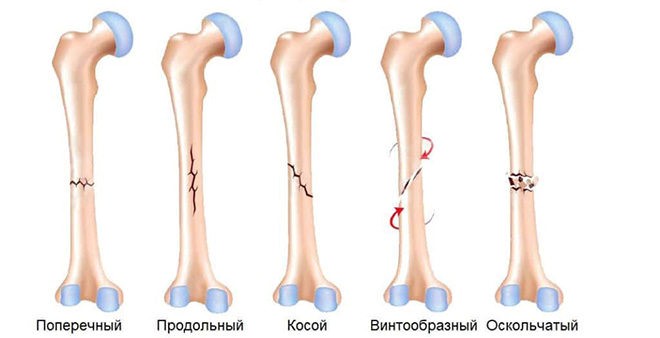 Виды переломов