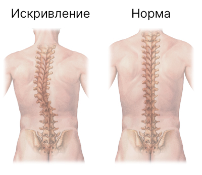 Искривление позвоночника